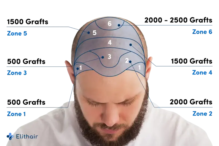 Map of hair loss areas on the scalp, indicating the number of grafts required for a transplant at Elithair.