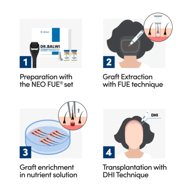 visual representation of the female hair transplant procedure using dhi method by elithair