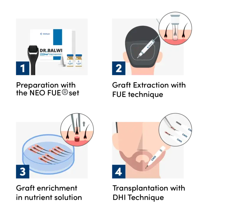 Infographic showing the 4 steps of the beard transplant with DHI Technic