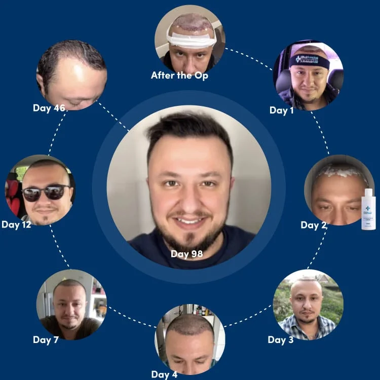 Infographic about the hair transplant recovery phases based on a Elithair patient
