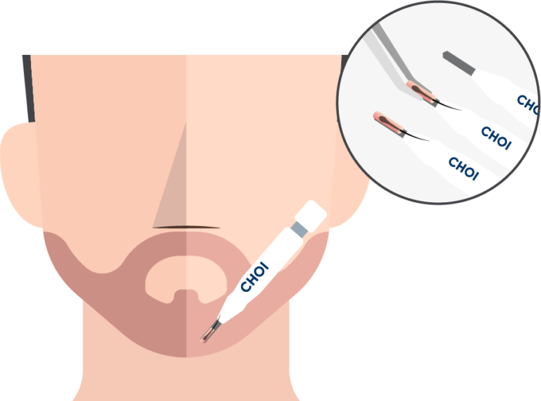 Illustration of graft insertion with the DHI technique for a beard transplant