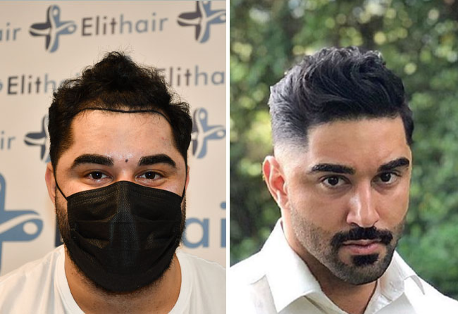 Natural hairline design hair transplant &ndash; Leonardo Seker, 3,750 grafts DHI