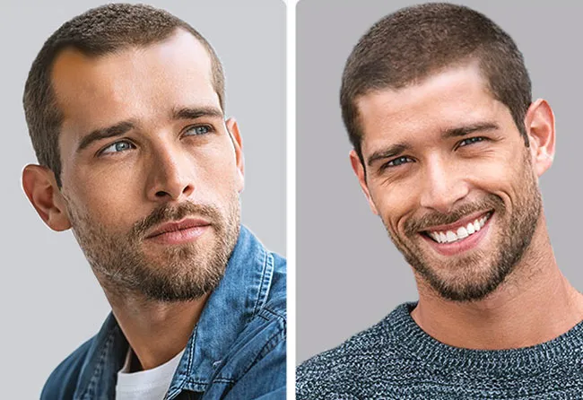 Patient Before and After PRP Treatment at Elithair
