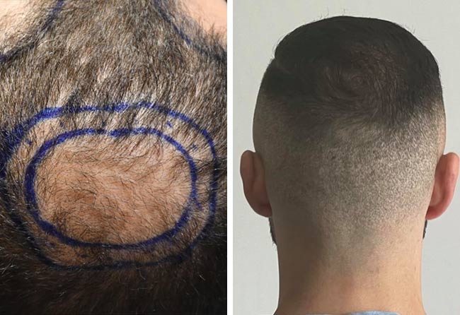 Mid-scalp healing &ndash; Salvatore B., 4,000 Grafts DHI