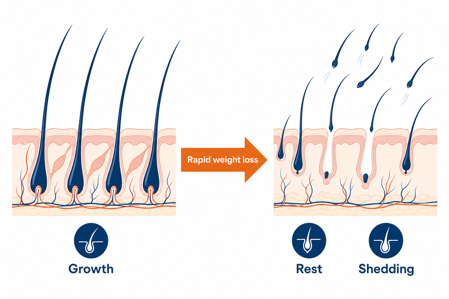 Diagram of the hair growth cycle showing follicles shifting to the resting phase after rapid weight loss.
