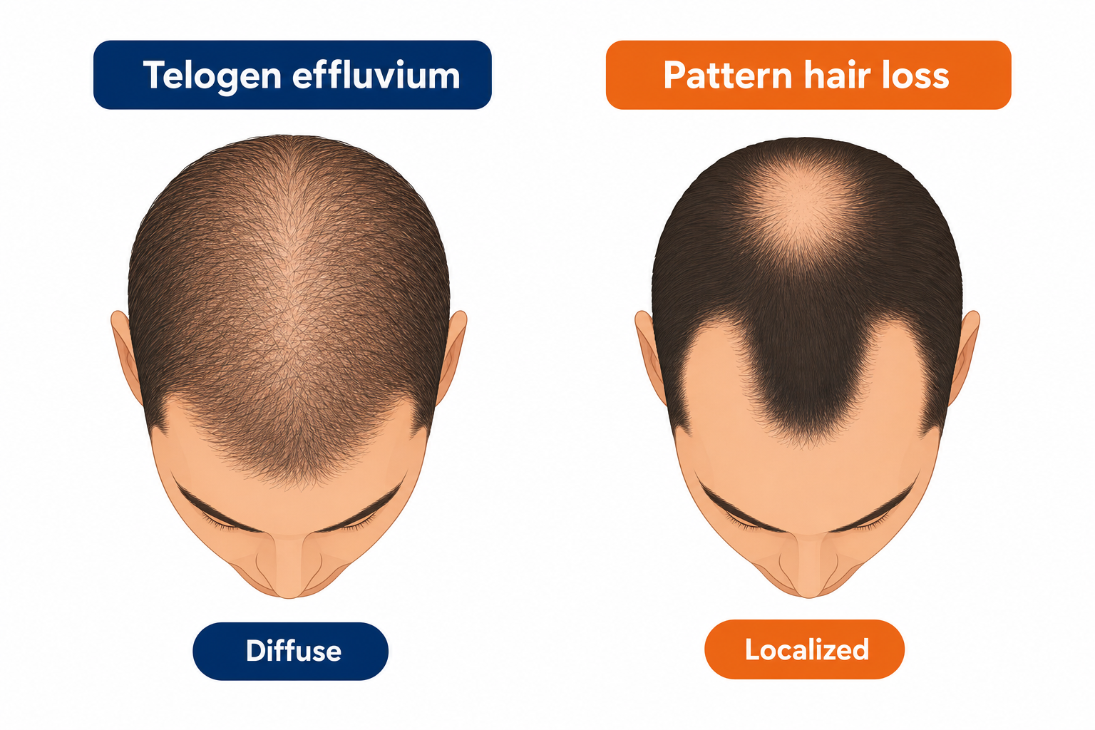 Comparison of diffuse telogen effluvium across the whole scalp versus localized pattern hair loss.