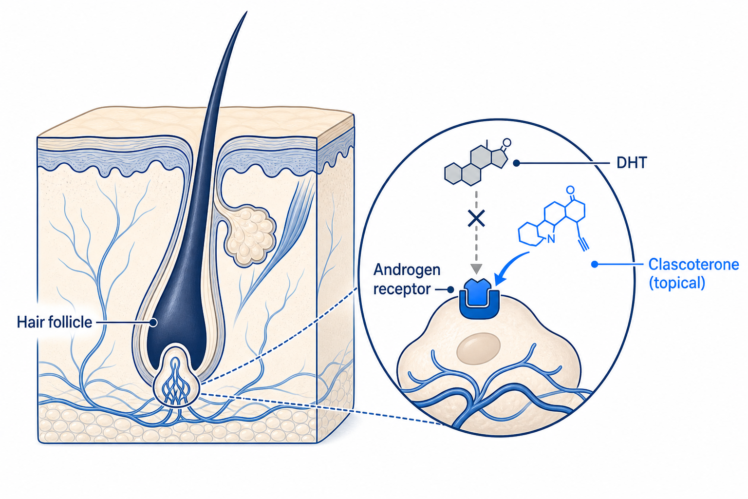 Illustration: clascoterone blocks the androgen receptor at the hair follicle and displaces DHT