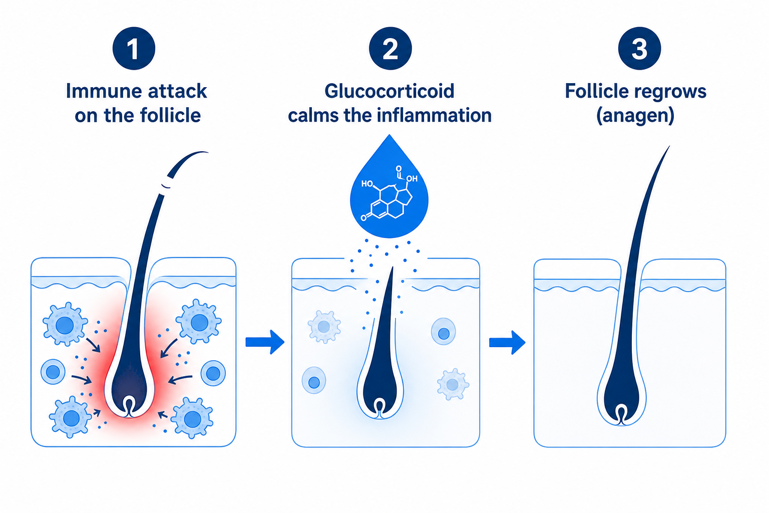 Infographic: how glucocorticoids dampen the immune attack on the hair follicle and enable regrowth