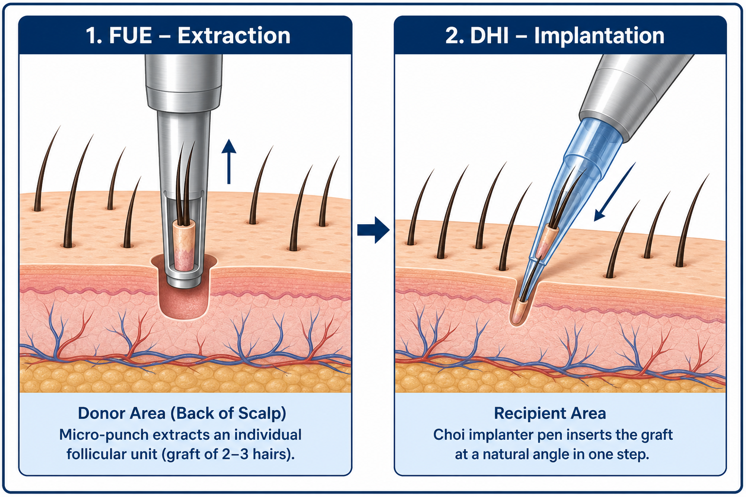How a hair transplant works: FUE extraction of the grafts on the left, DHI implantation with the CHOI pen on the right