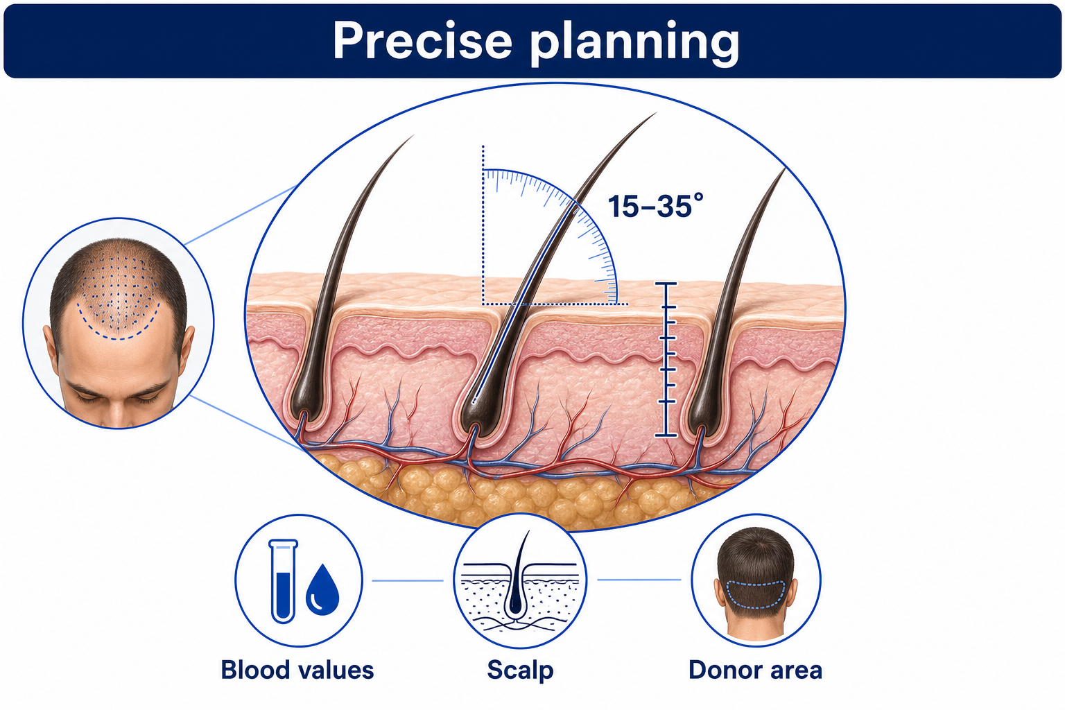 Precise planning of a hair transplant: implantation angle of 15 to 35 degrees, scalp and donor area analysis