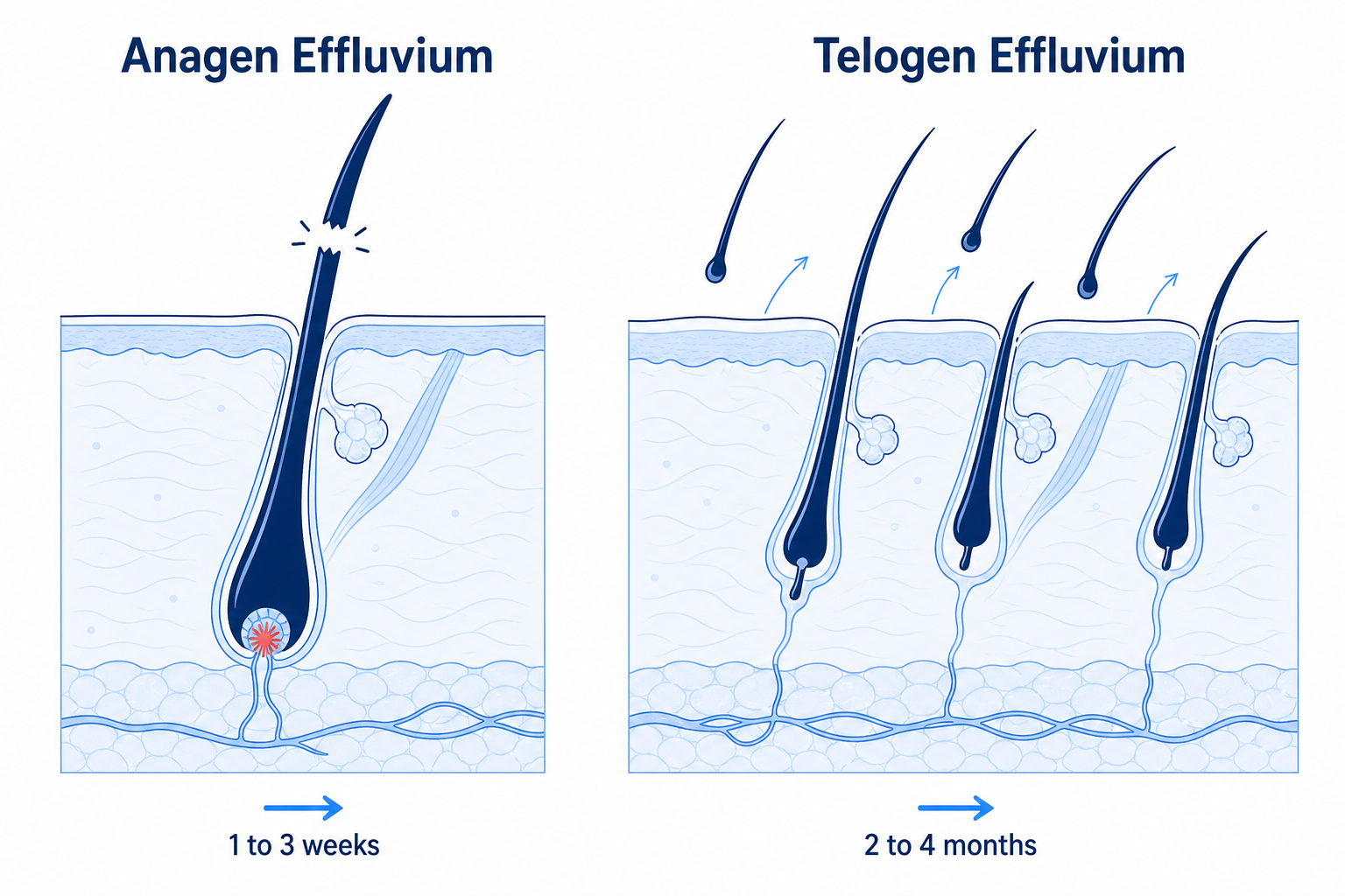 Comparison of anagen and telogen effluvium: hair breakage in the growth phase after 1 to 3 weeks versus diffuse shedding in the resting phase after 2 to 4 months
