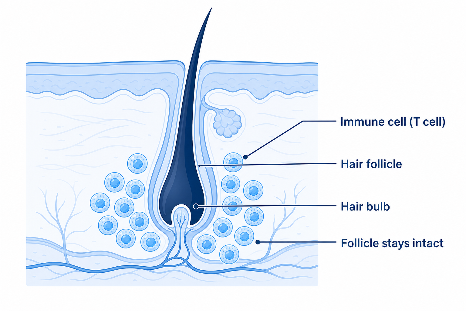 Autoimmune mechanism in alopecia areata: immune cells attack the hair bulb while the follicle stays intact