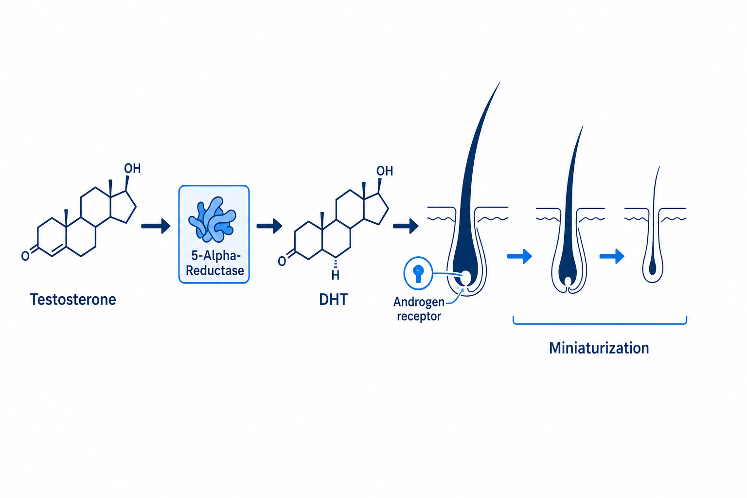 Diagram of the DHT pathway: testosterone, 5-alpha-reductase, DHT and miniaturization of the temple follicle