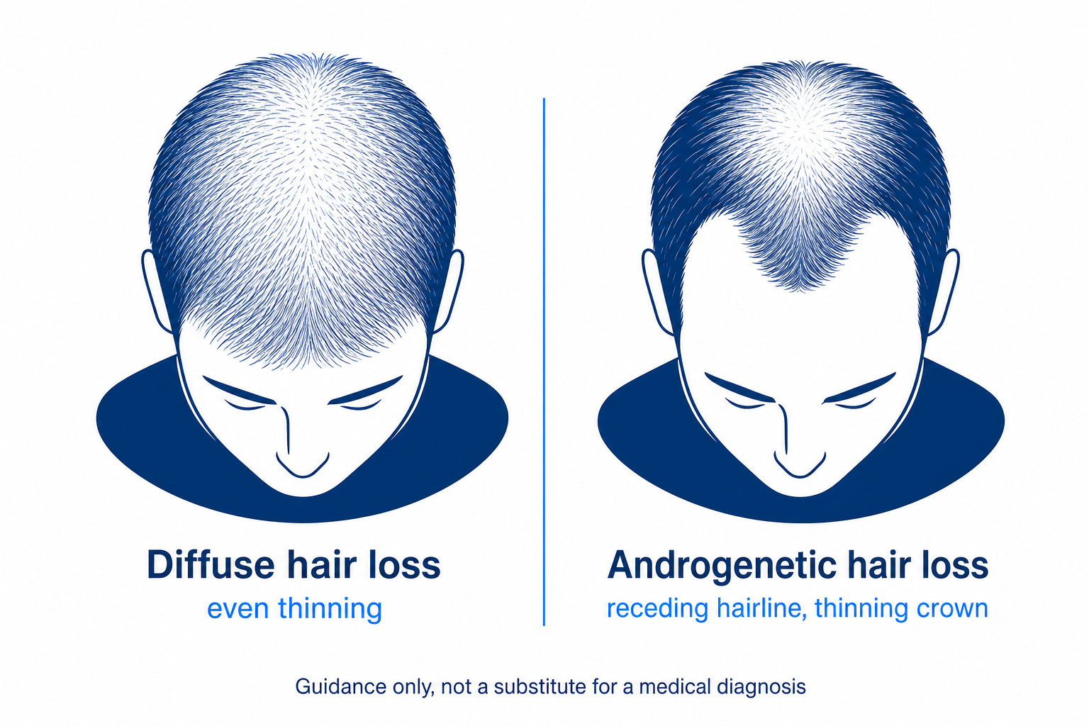 Comparison diagram of diffuse versus androgenetic hair loss, two head silhouettes with thinning patterns