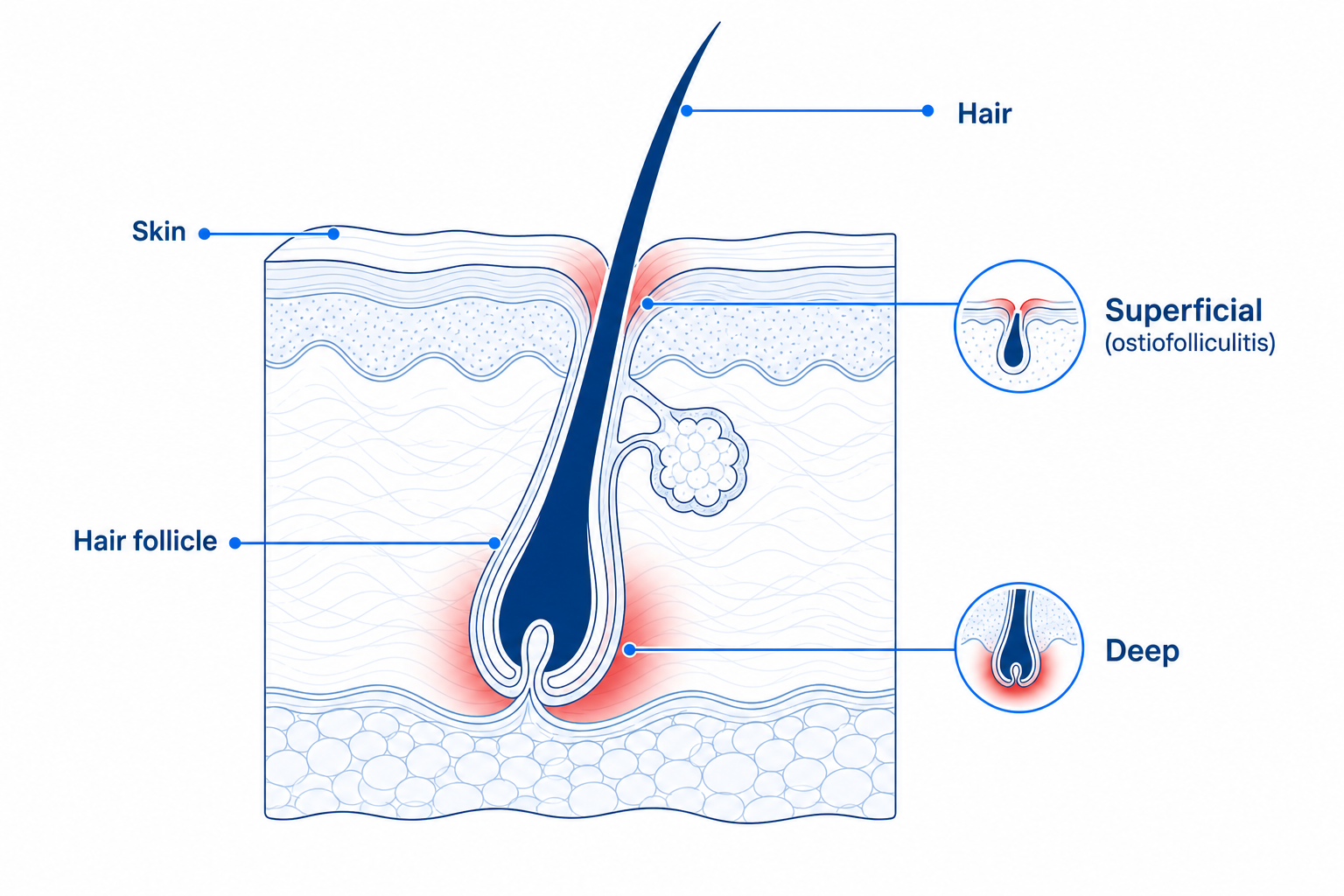 Cross-section of a hair follicle showing a superficial and a deep inflammation zone