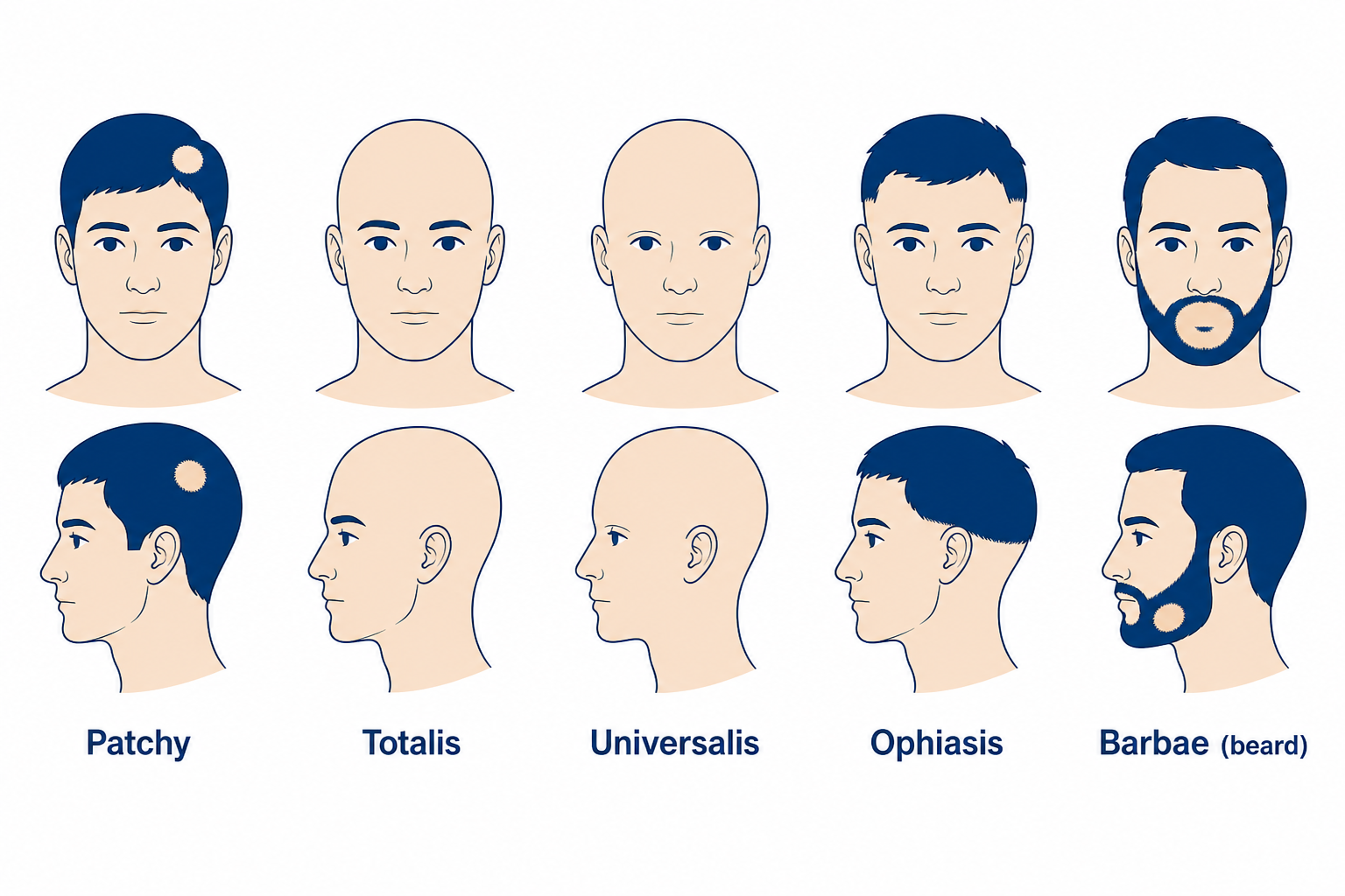Types of alopecia areata: patchy, totalis, universalis, ophiasis, and barbae