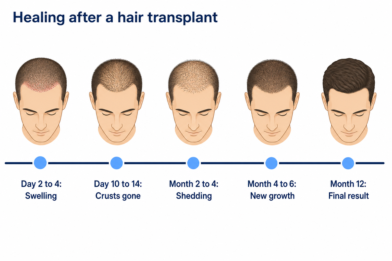 Healing timeline after a hair transplant from day 2 to month 12