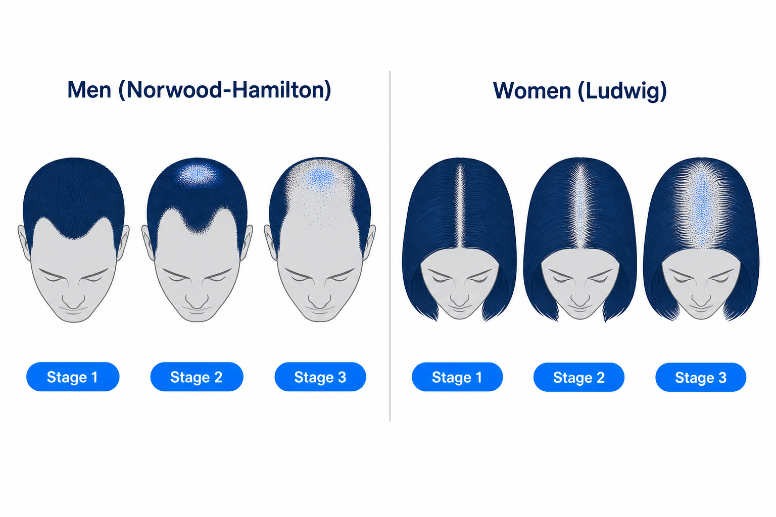 Schematic comparison of hair loss patterns in men (Norwood-Hamilton) and women (Ludwig) with androgenetic alopecia
