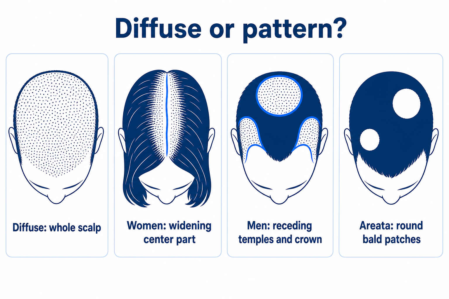 Comparison of four hair loss patterns: diffuse thinning across the whole scalp, a widening center part in women, receding temples and crown in men, and round bald patches in alopecia areata