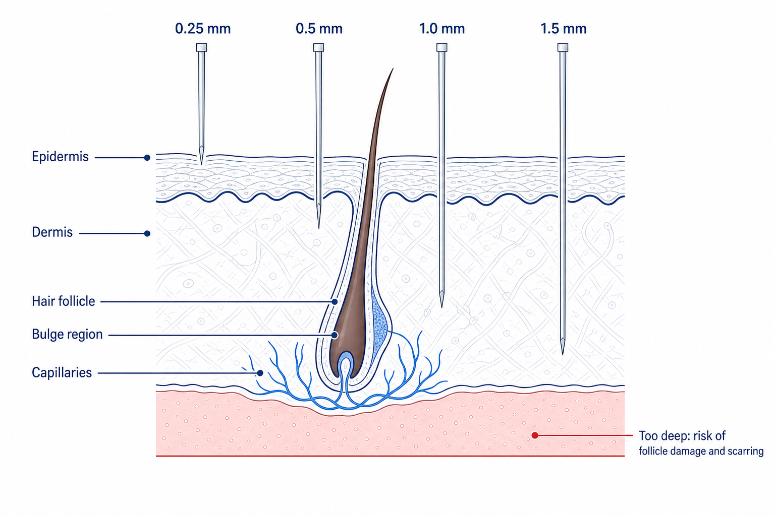 Cross-section of the scalp showing needle lengths from 0.25 to 1.5 mm and the risk zone for follicle damage