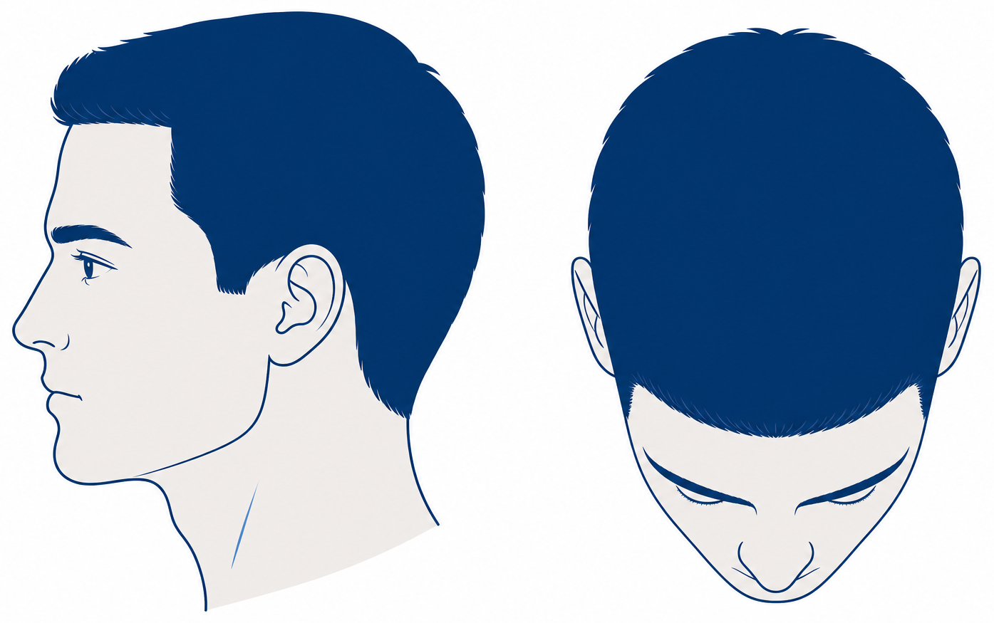 Norwood 1 in profile and from above: full youthful hairline, dense crown