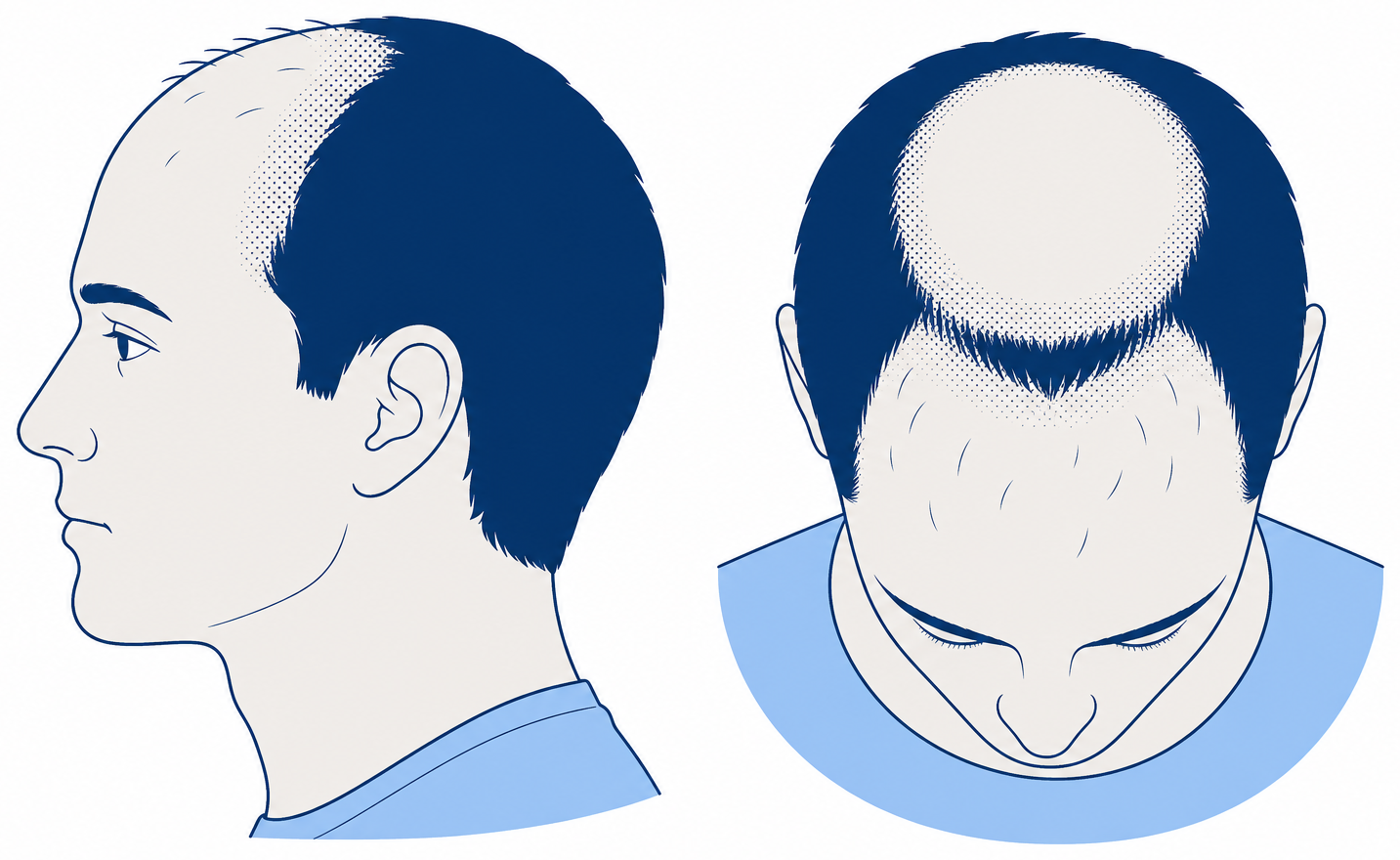 Norwood 4 in profile and from above: large bald forehead zone, bald crown, narrow band of hair between them