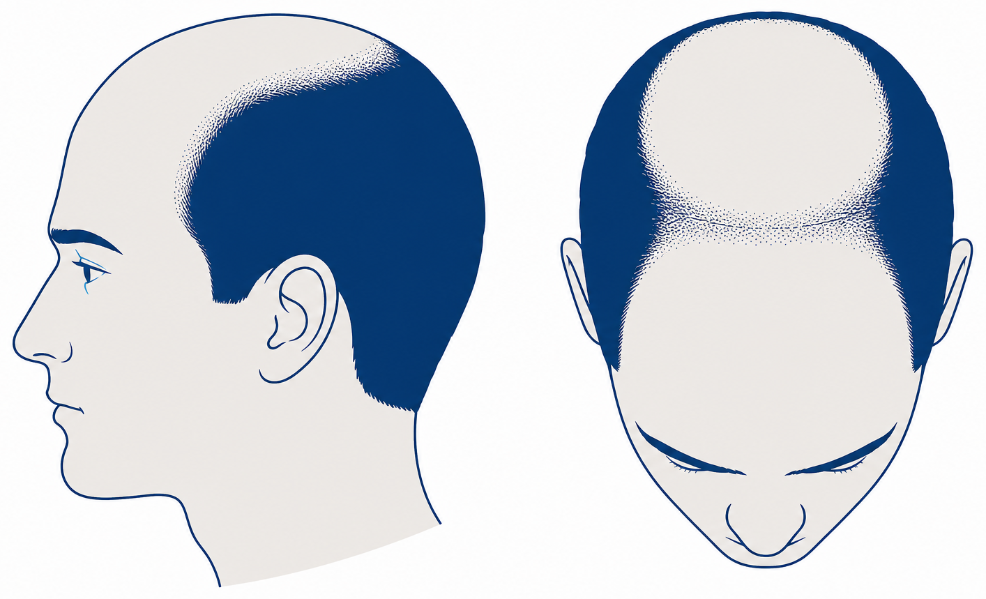 Norwood 5 in profile and from above: narrow, thin band of hair between forehead zone and crown