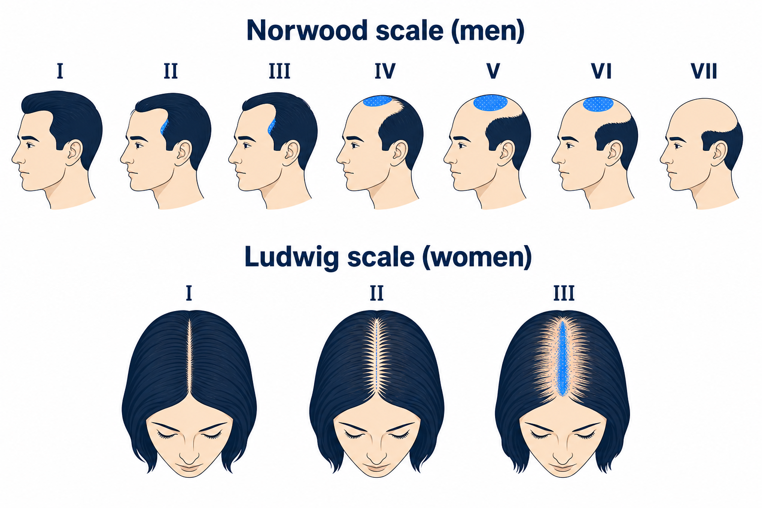 Norwood scale for men and Ludwig scale for women to classify pattern hair loss