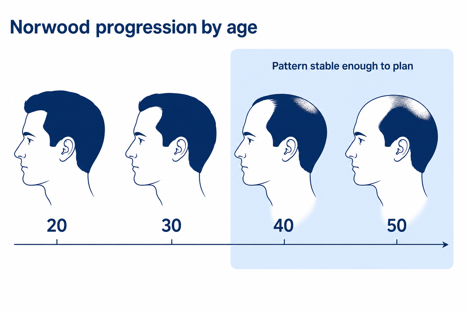 Timeline of Norwood progression: hair loss advancing with increasing age