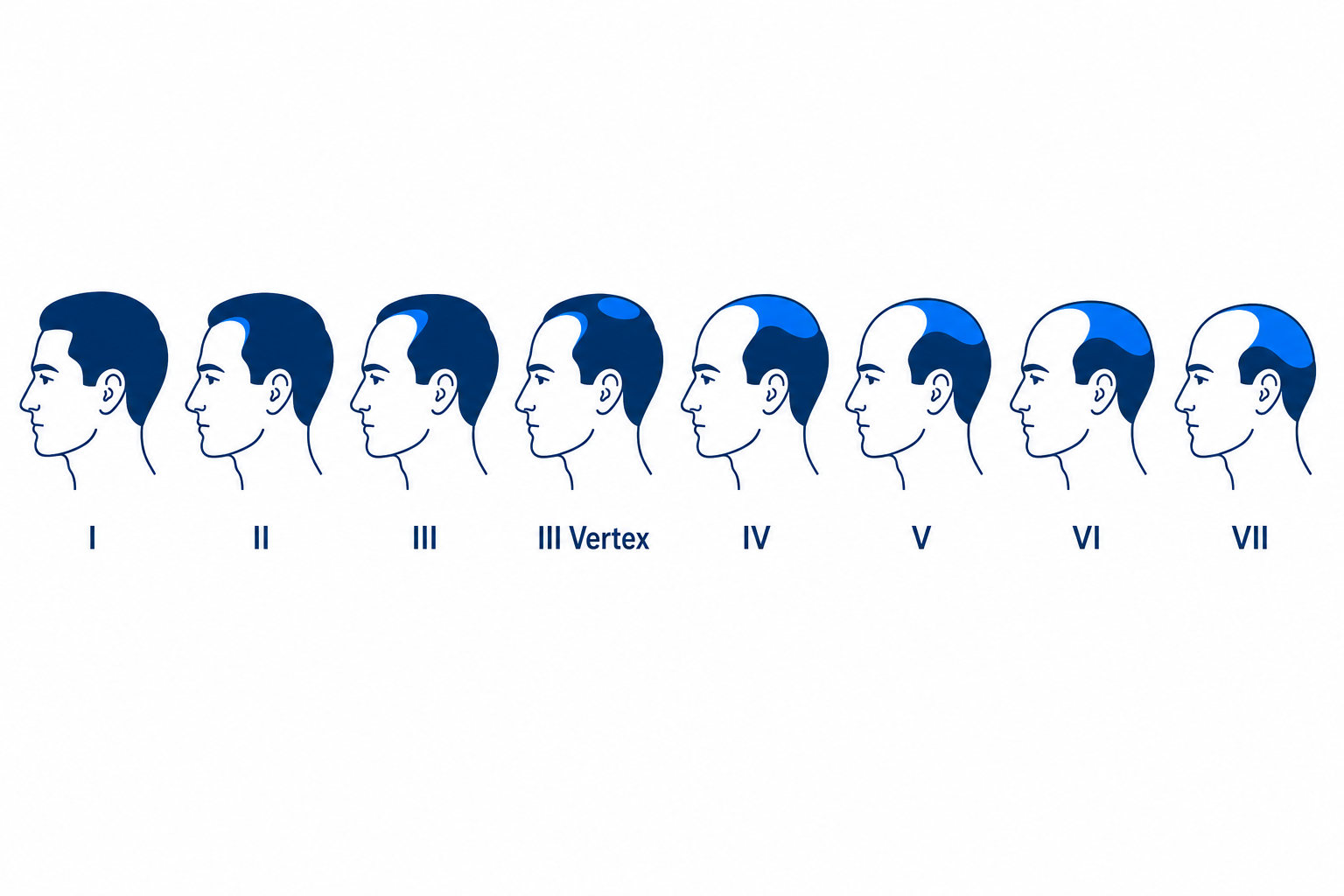 Hamilton-Norwood scale from stage I to VII with a progressively receding hairline