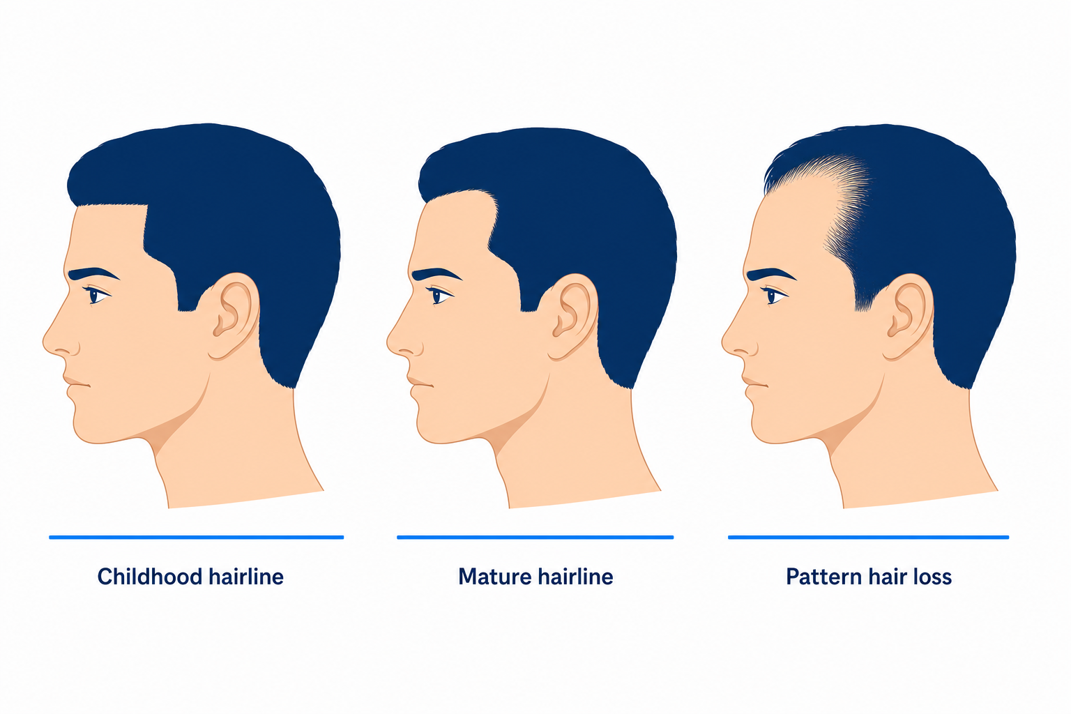 Three head profiles compared: childhood hairline, mature hairline and pattern hair loss