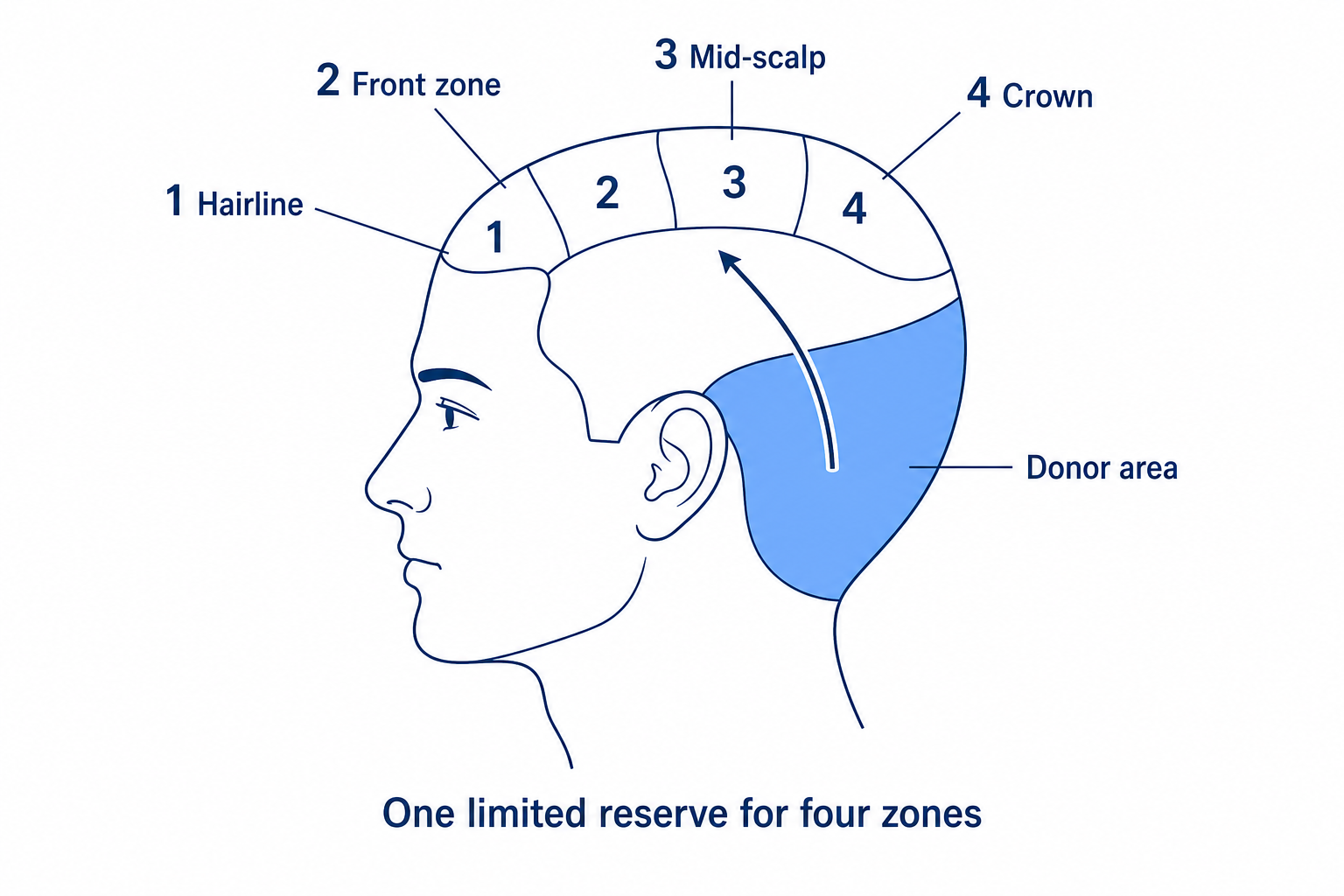 Diagram: the limited donor area at the back of the head supplies four numbered recipient zones from the hairline to the crown