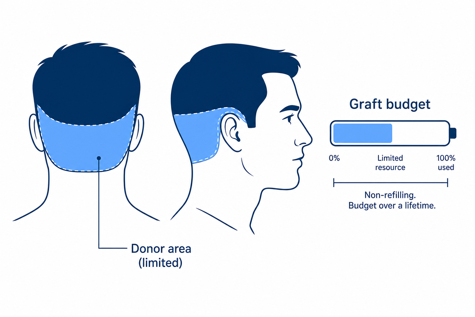 Diagram of the limited donor area at the back of the head as a graft budget for a lifetime
