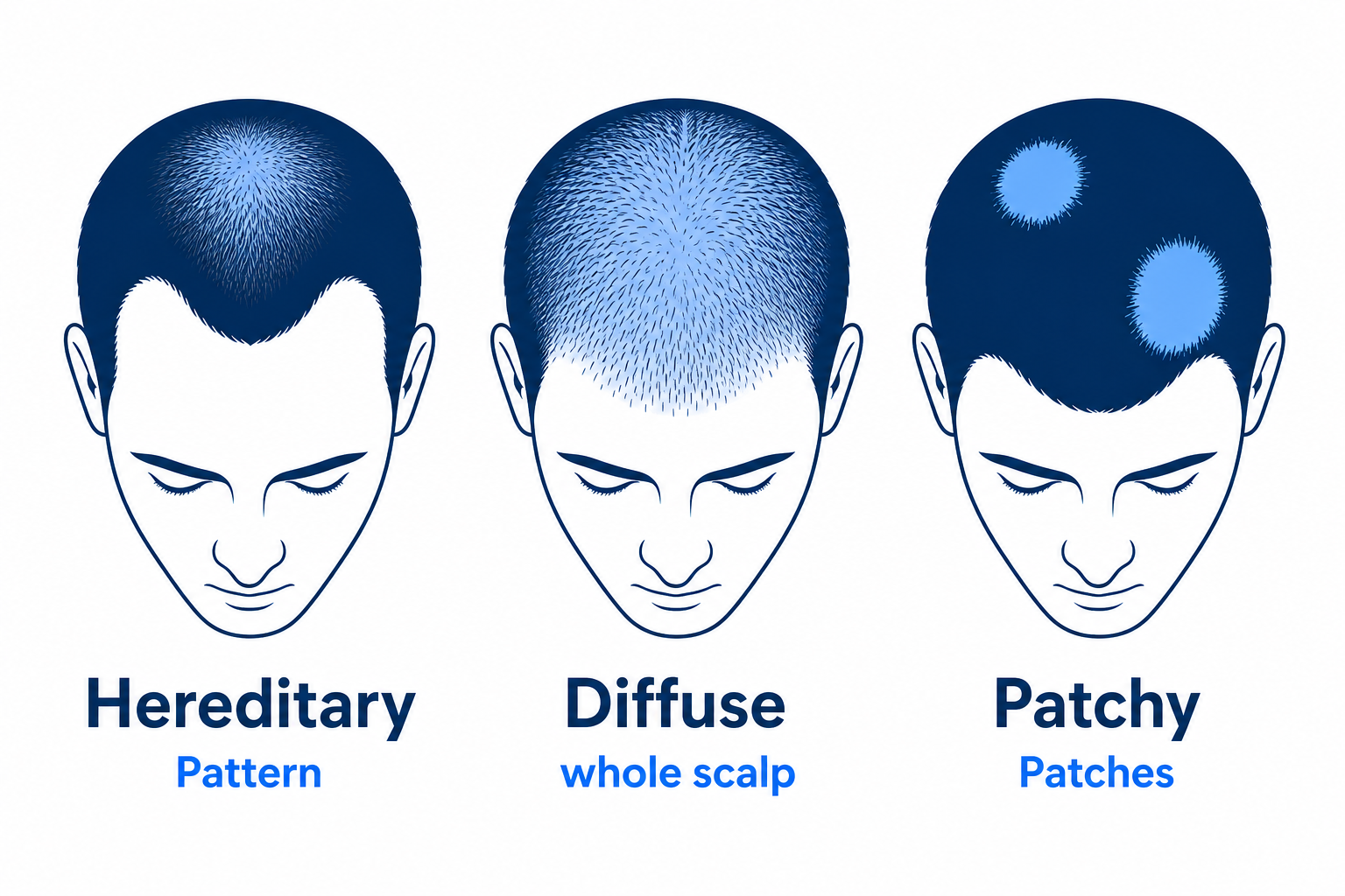Infographic of the three hair-loss types: hereditary, diffuse, and patchy