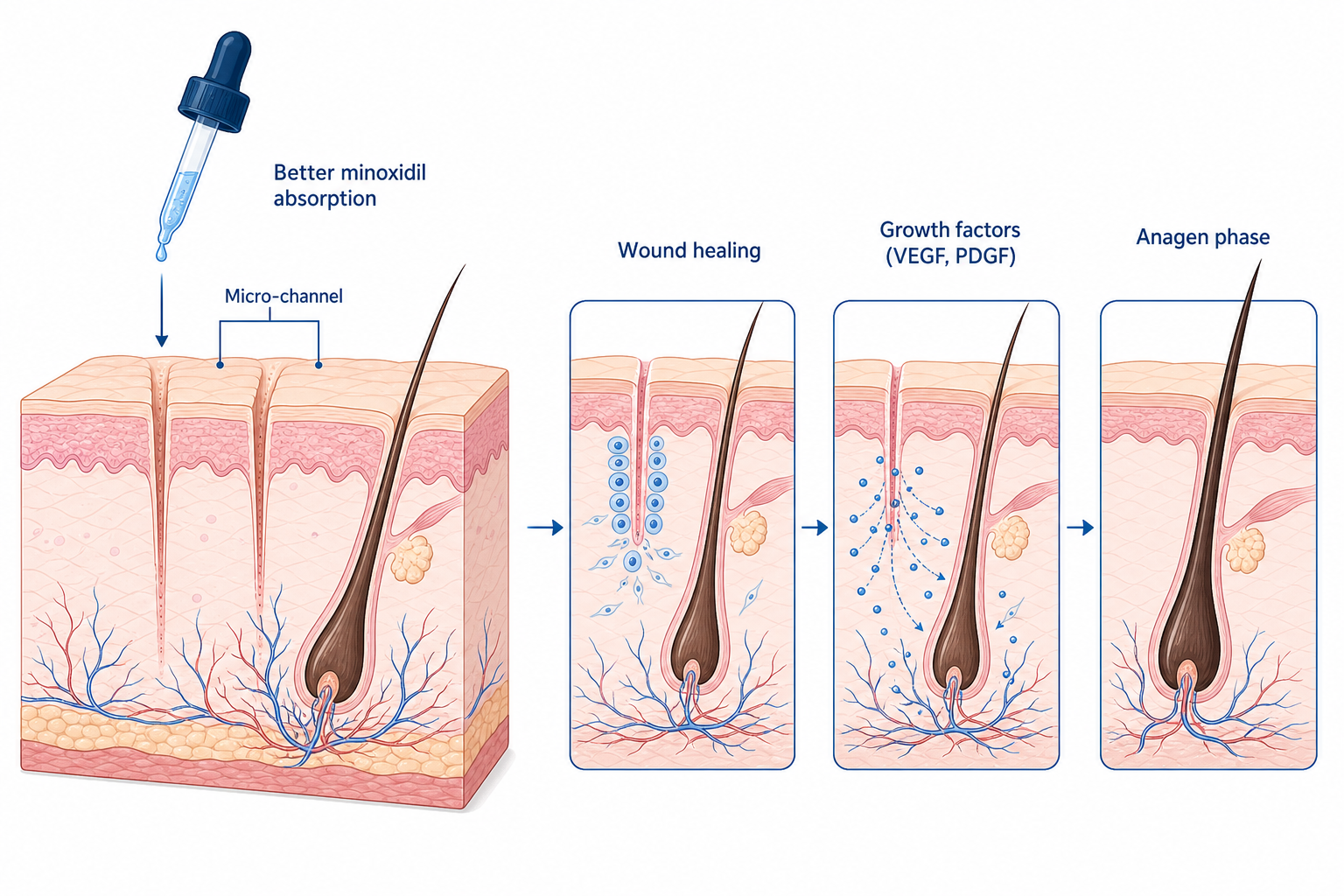 Illustration of how microneedling works on the scalp: micro-channel, wound healing, growth factors and the anagen phase