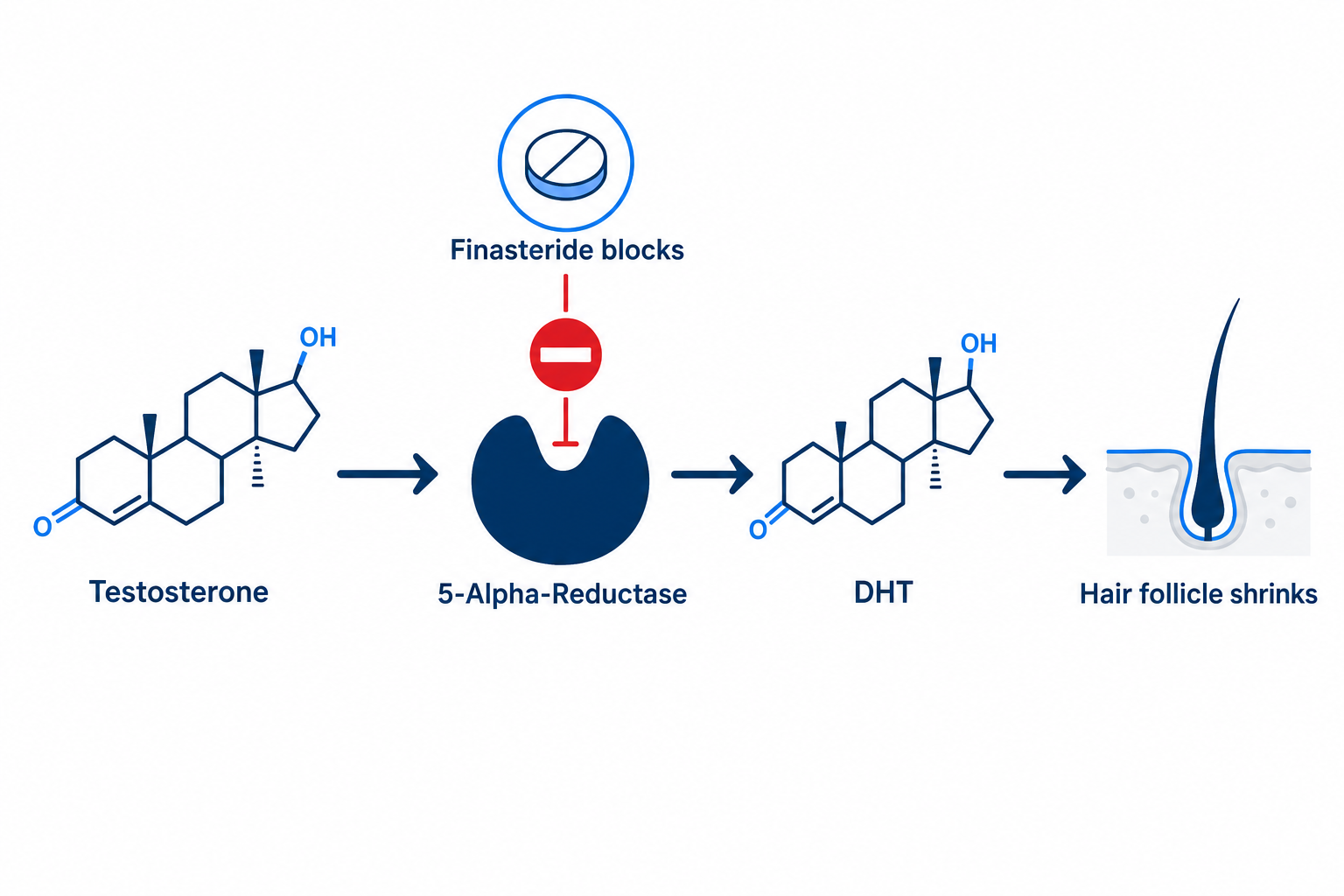 Diagram of the finasteride mechanism of action: finasteride blocks 5-alpha-reductase and lowers DHT