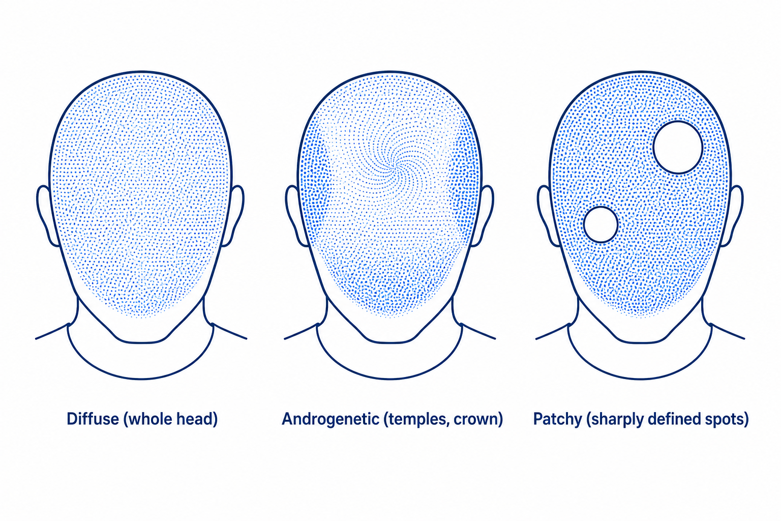 Comparison of the three loss patterns: diffuse, androgenetic, and patchy, shown as head silhouettes