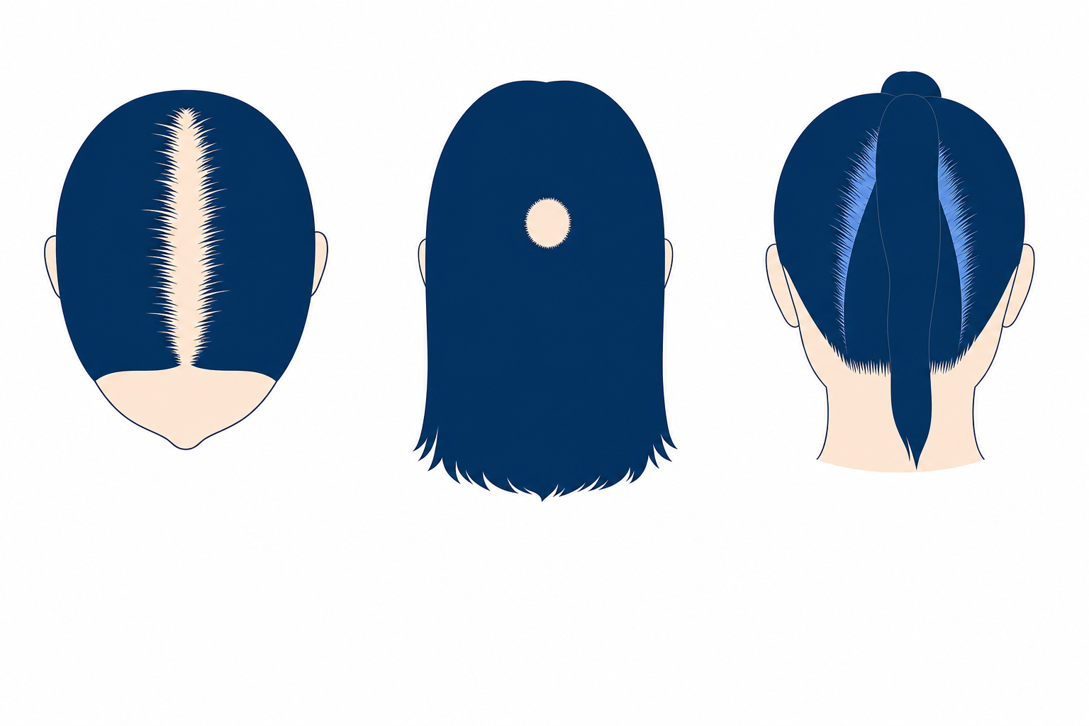 Three schematic female heads: a widened center part, a round patch at the back of the head and thinning along the tension line