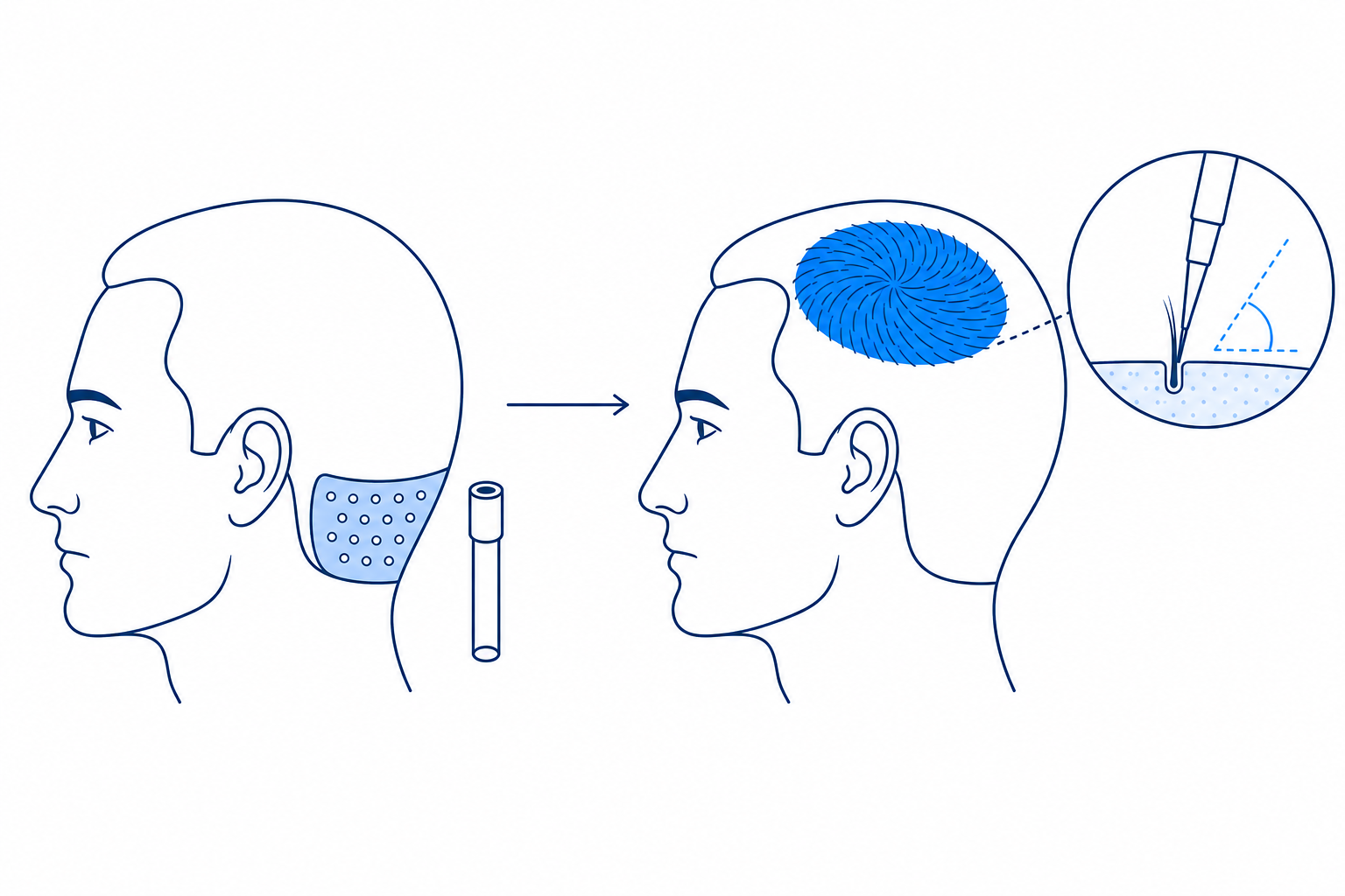Diagram of extraction from the occipital donor area and implantation with growth direction in the whorl area