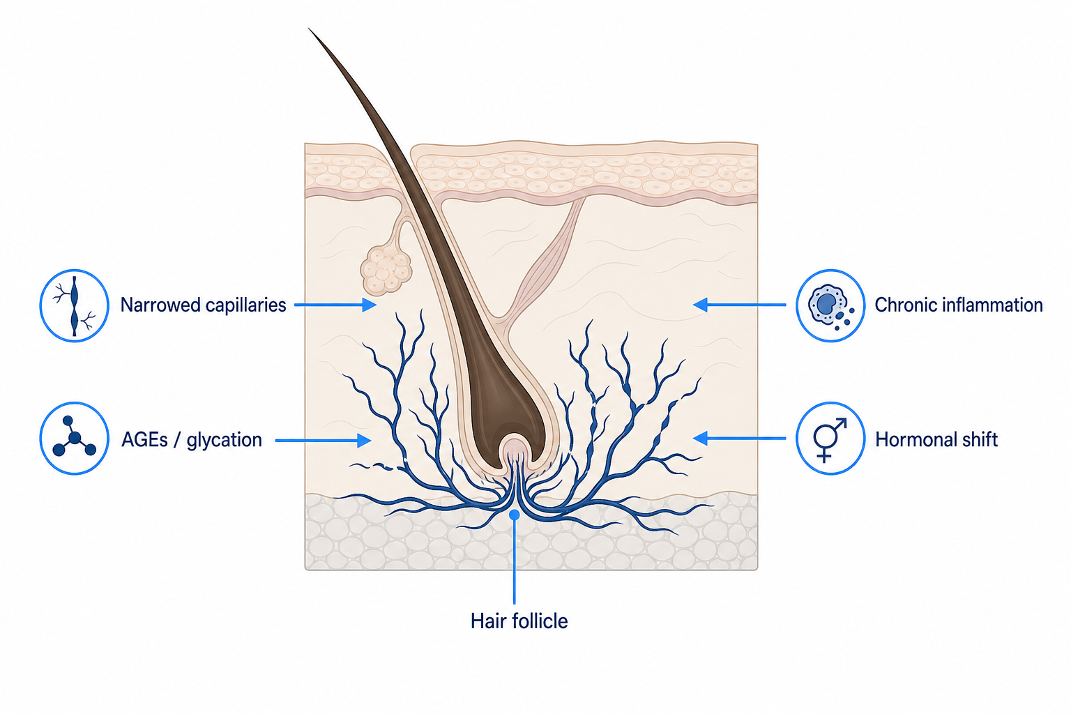 Illustration of a hair follicle in a cross-section of the skin with the four mechanisms by which diabetes disrupts hair growth