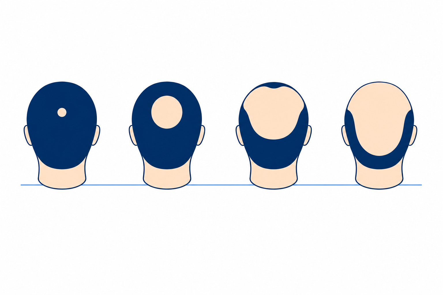 Four schematic backs of heads show the thinning patch at the whorl growing until only the rim of hair remains