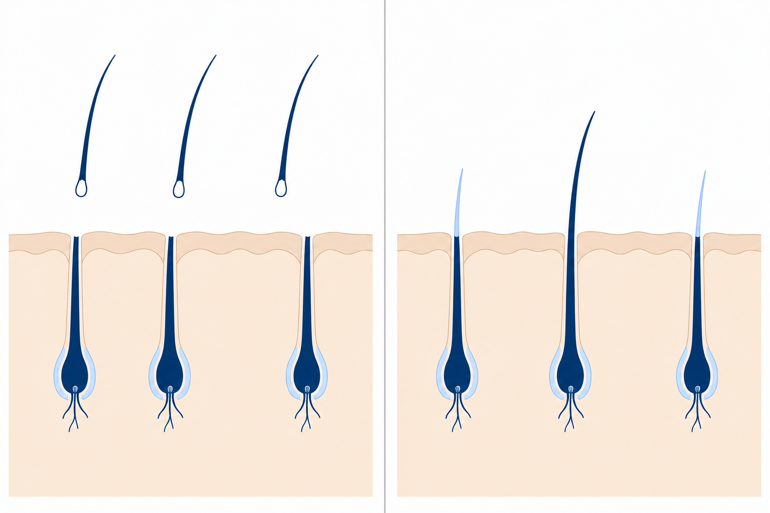 Schematic cross section of the skin: on the left the hair shaft detaches and the root remains, on the right surrounding native hairs enter the resting phase