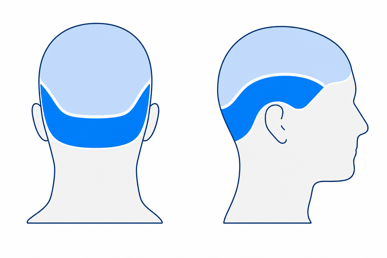 Head diagram from behind and in profile, with the donor zone at the back of the head and the recipient zone on the top of the head marked in color