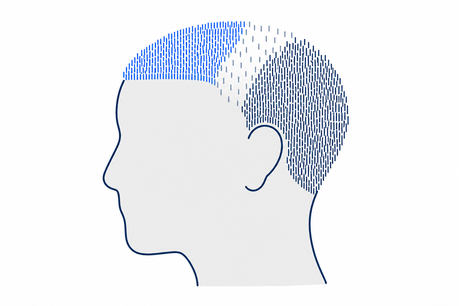 Head profile with a dense transplanted area and a visible step down to the thinning native hair behind it