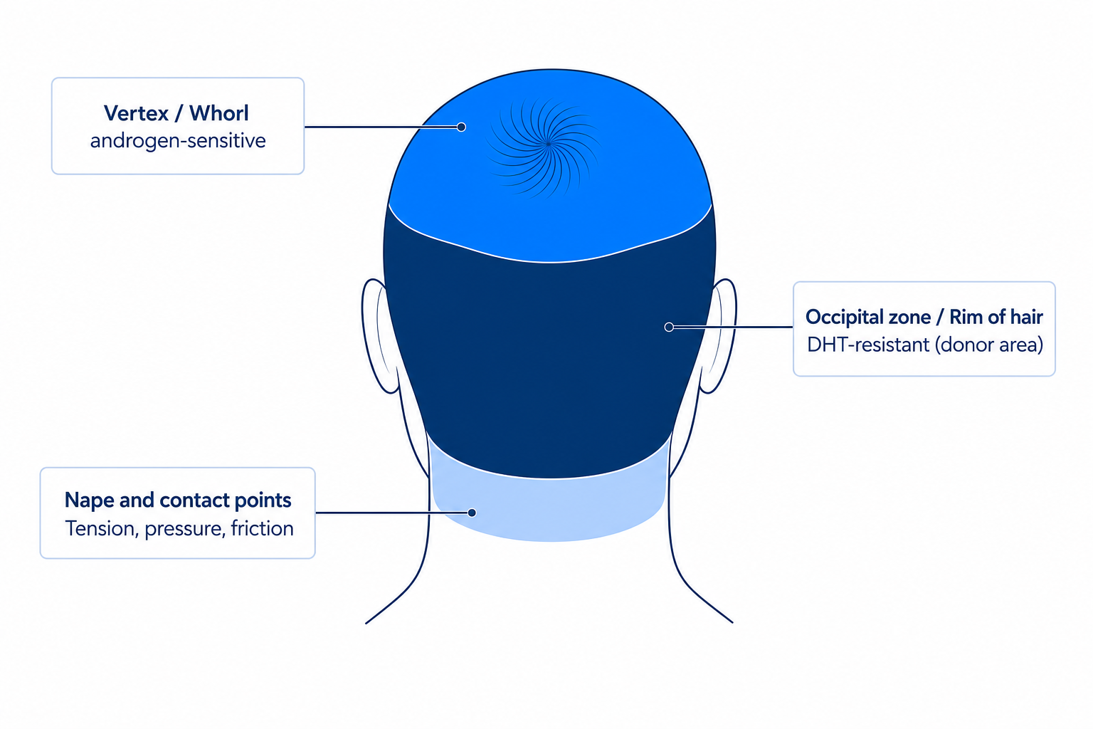 Zones of the back of the head: vertex with whorl, occipital donor area and nape with their typical causes