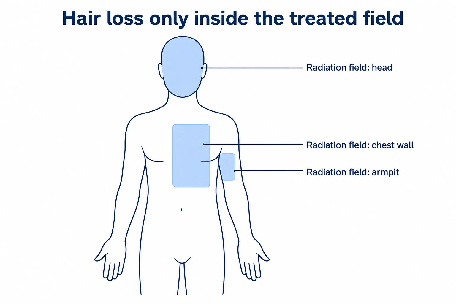 Infographic: body silhouette with the radiation fields for head, chest wall and armpit; hair loss occurs only in the marked field
