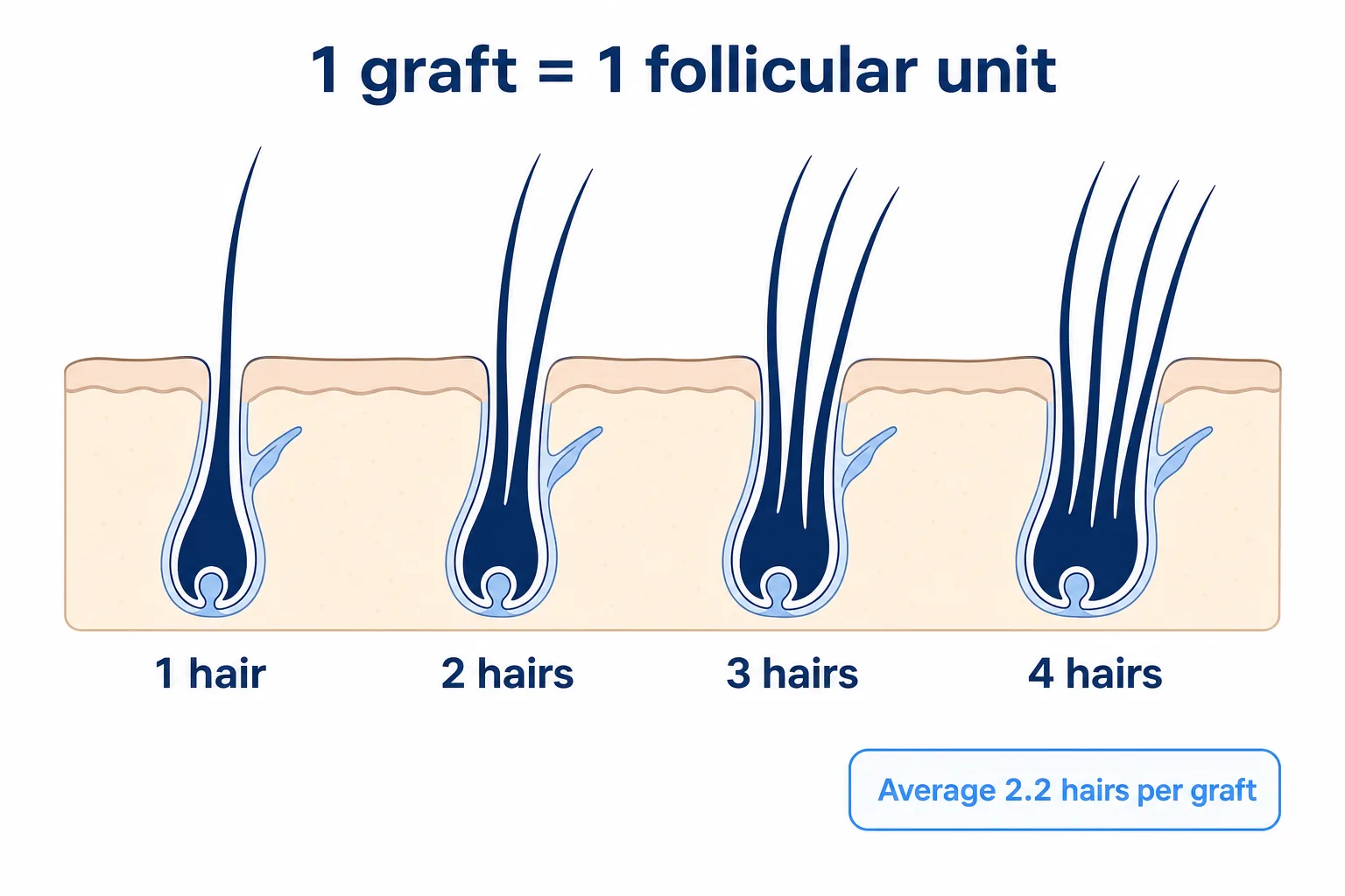 Infographic: four follicular units with one, two, three and four hairs in a scalp cross-section