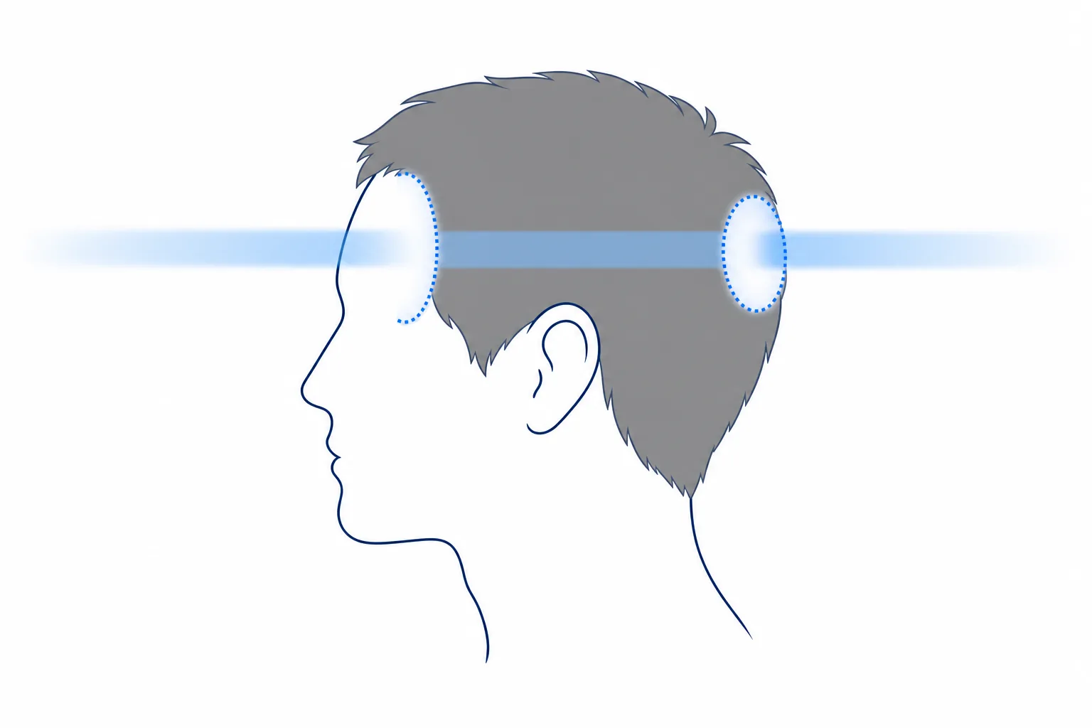 Illustration of a head in profile: the beam creates bald patches at the entry point and at the exit point on the opposite side
