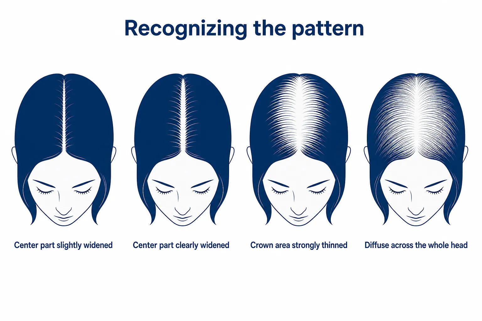 Comparison of hair loss patterns in women: a widened center part and diffuse thinning