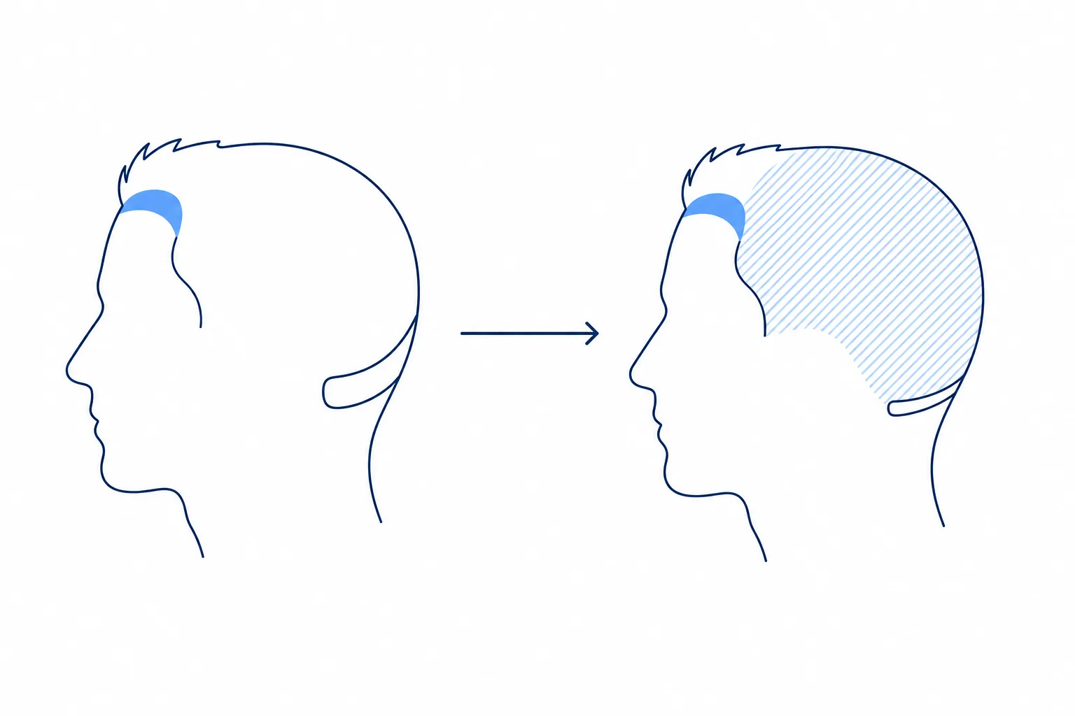Illustration of two head profiles: the zone treated today and the area that may be affected later